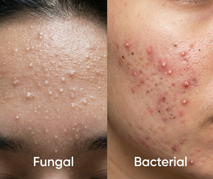 Acne Treatment Serum #2